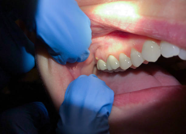 Best Emergency Denture Repair in Ramseur, NC
