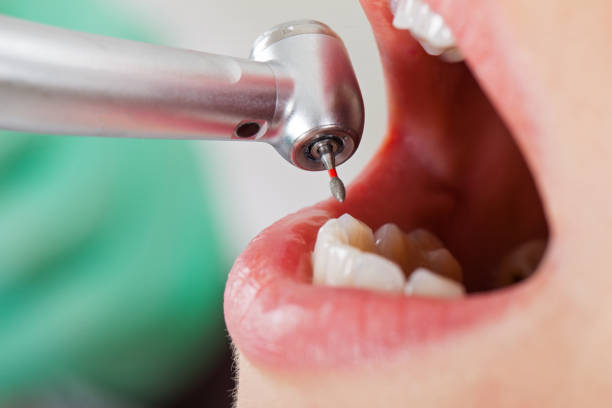 Best Emergency Wisdom Teeth Removal in Ramseur, NC